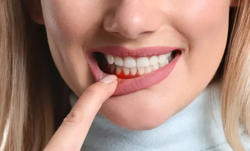 Hvordan vi behandler periodontitt på Estetika Tannklinikk?
