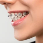 Hvordan fungerer tannregulering