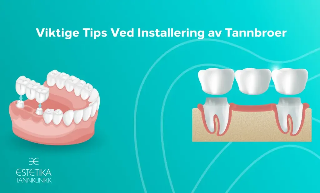 Viktige Tips Ved Installering av Tannbroer, tannbro