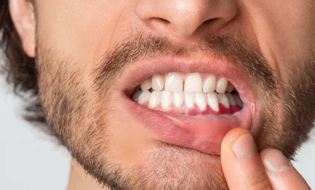 Betennelse i munnen og sårt tannkjøtt