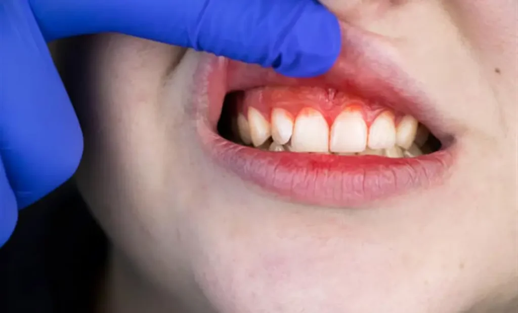 Betennelse i munnen og sårt tannkjøtt